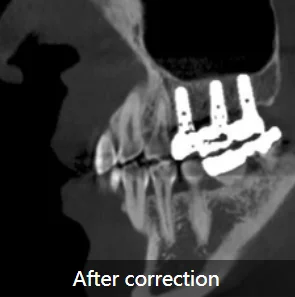  Нанимает 3d-панорамную визуализацию CBCT цифровая стоматологическая рентгеновская машина