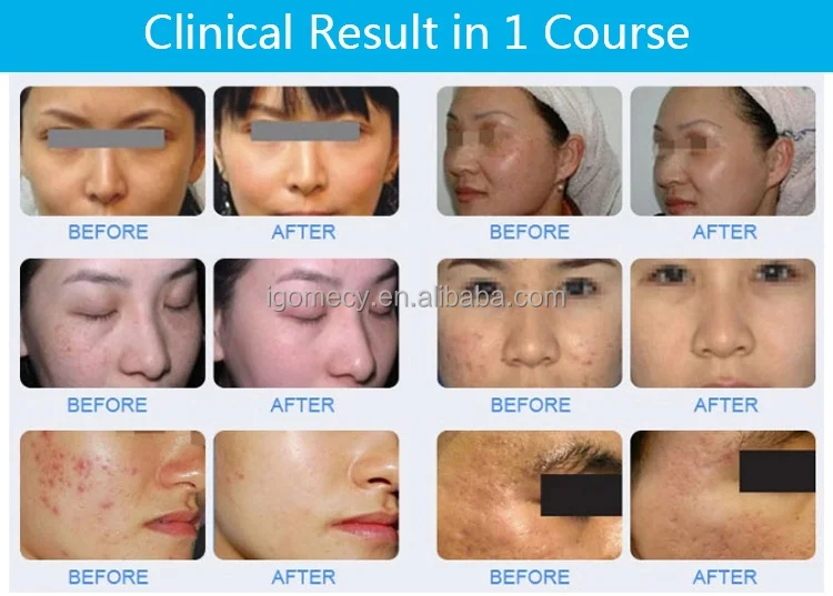  Er-Yag-laser-erbium-glass-fractional-laser/ 1550nm -erbium-glass-fiber-laser-stretch-mark-treatment  1550nm-fiber-erbium-glass-laser acne-treatment-machine 1550nm-erbium-glass-fiber-laser