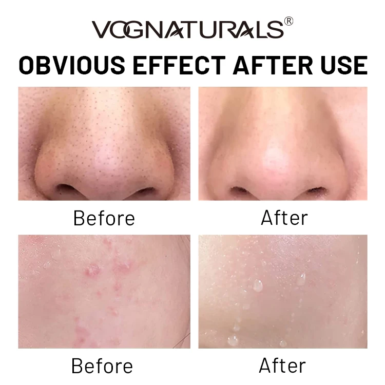 Private Label Facial Cleanser Blackhead Removal Cleanser 10% Benzoyl Peroxide Anti Acne Foaming Face Wash