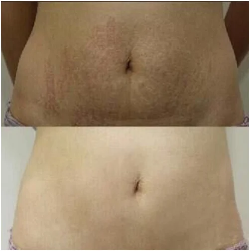 portable gold rf microneedling machine face lifting radiofrequency micro needle fractional rf microneedle machine