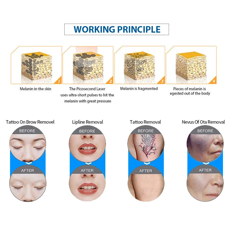 2025 Professional Wholesale Price Q-switch Nd Yag Portable Laser Tattoo Removal Machine nd yag laser for sale