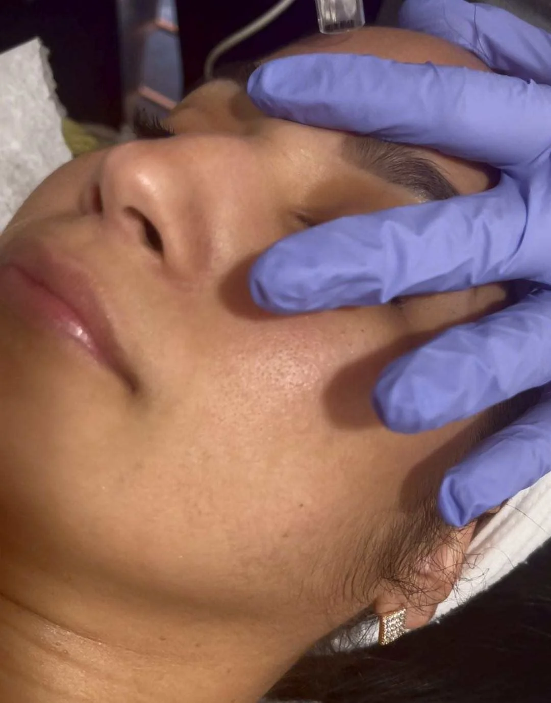 Hot Sell Cosmetic Clinical 12ml Blue Blood PRP Tube Sodium Citrate Gel PRP Injection for Face v Lifting Skin Care Knee joint