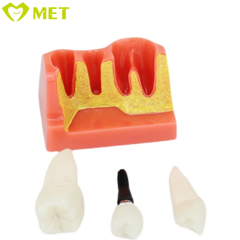 Meite medical 4 Times dental implant model/dental teaching model/dental removable teeth model