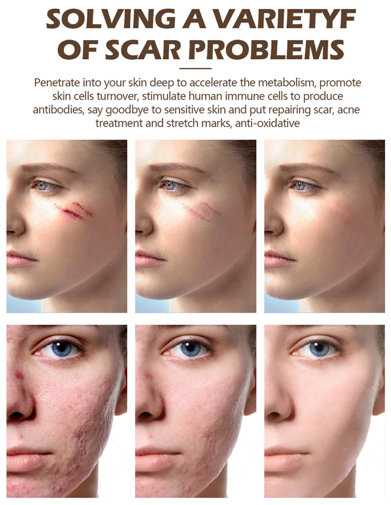 Customize Logo 30g Women Face Body Care Scar Repair Cream Acne Treatment Firming Fast Effective Scar Removal Cream