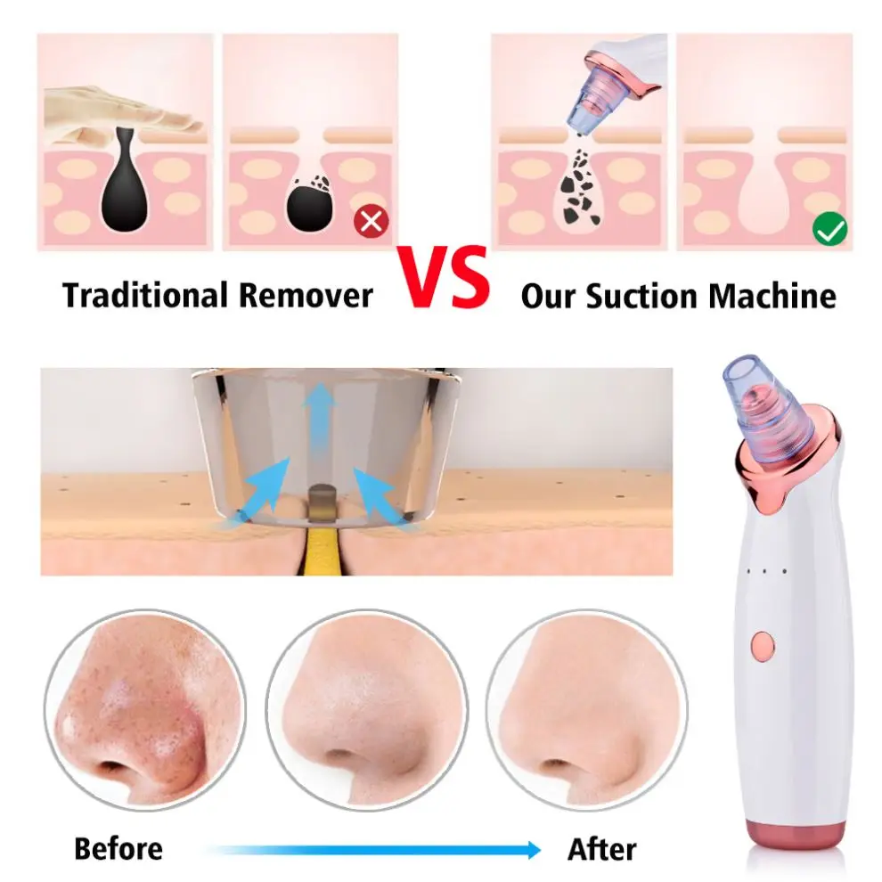 Pore Cleaner Black Head acne treatment Suction Extractor facial and whitehead electronic blackhead remover vacuum
