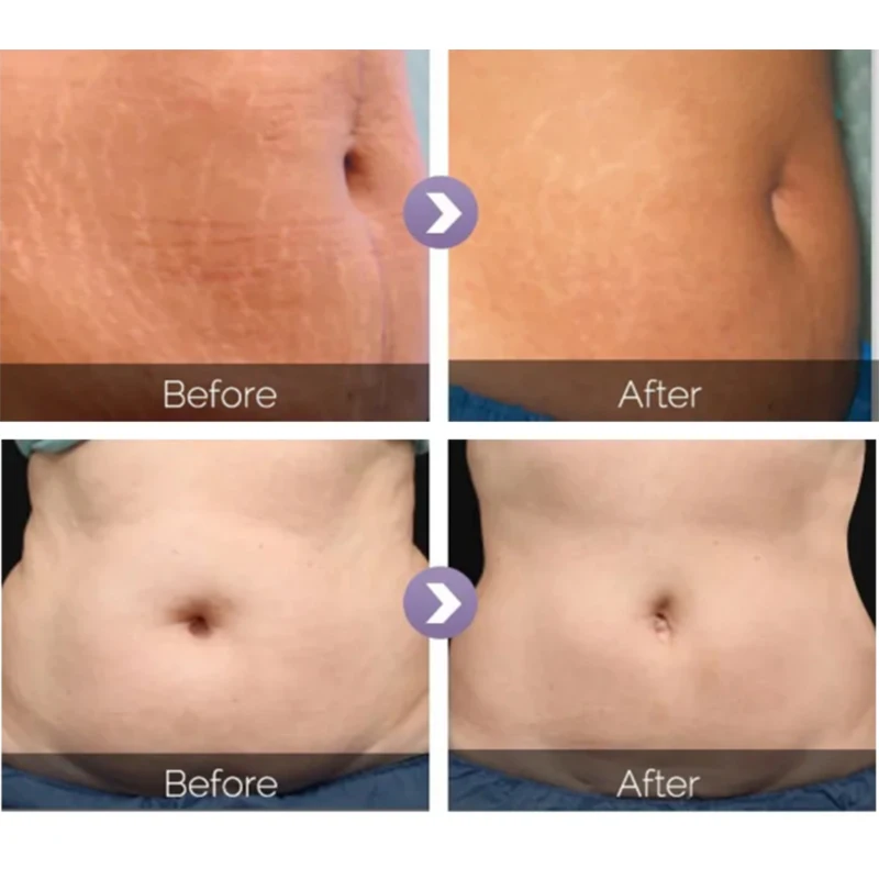 9 In 1 Cavitation Vacuum shaping System Vella Starvac 80k Cavitation Slimming Shape Vaser Liposuction Machine