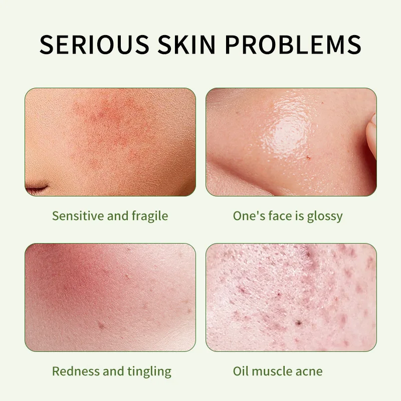 Private Label Beauty Skin Care 30ml 50ml Whitening Salicylic Acid Acne Treatment Face Cream