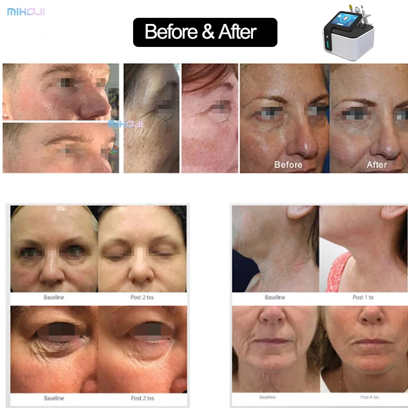 Cool Jet Plasma for Face Cold Plasma Looking For Distributor Eyelid Tightening And Lifting Fractional Plasma Device