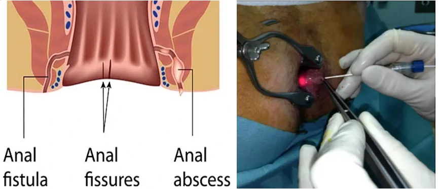 anal fistula hemorrhoid.png