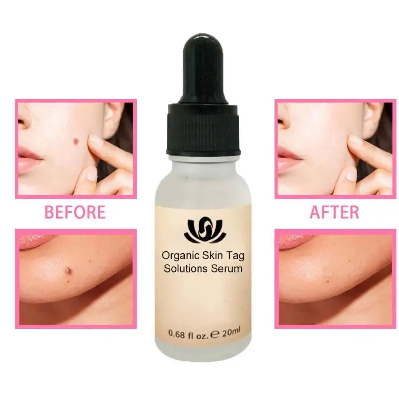 Organic Tags Solutions Serum 30g No Trace Painle Skin Tag Remover Serum Mole Removal Cream Painless Face Wart Mole Freckle TSLM1