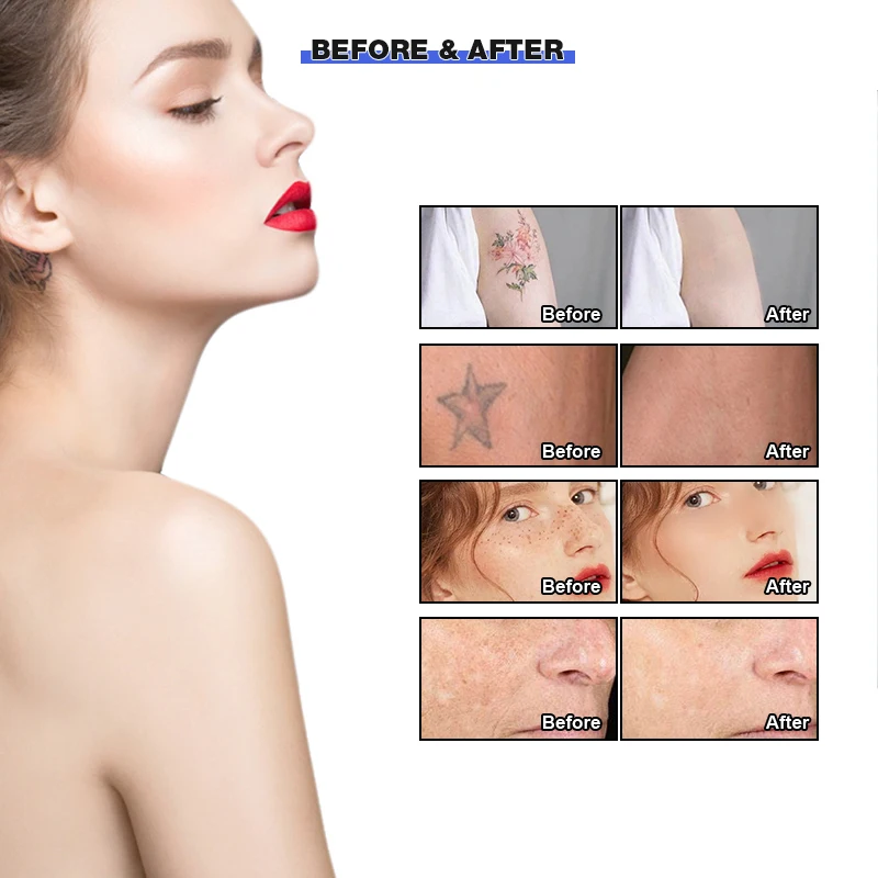 skin whitening q switched nd yag laser tattoo eyebrow remover laser removal machine ce