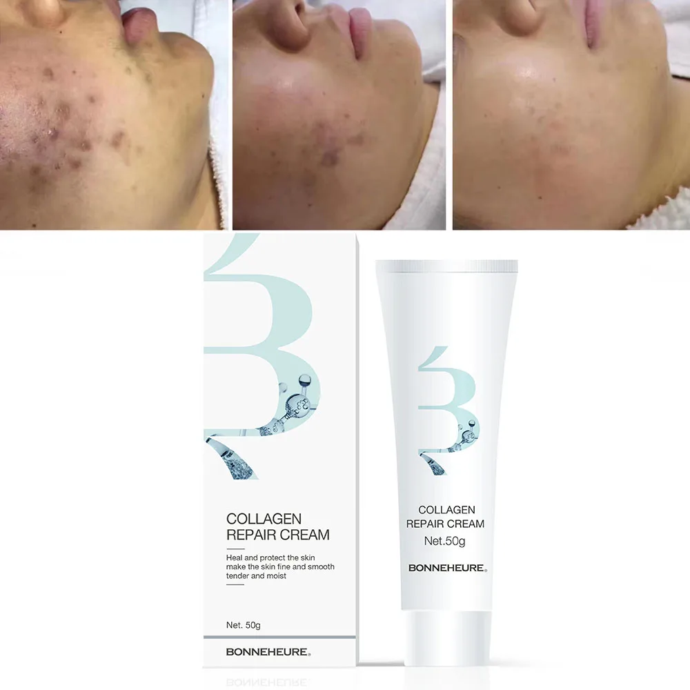 100% Natural Stretch Mark Remove Cream Scar Repair Cream Collagen Acne Scar Removal Cream Smooth Skin Scar Care