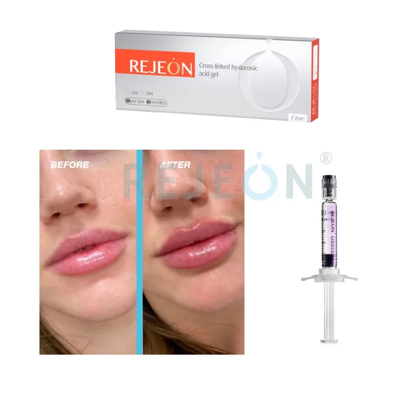 REJEON hyaluronic acid filler injection deep hyaluronic acid gel 10ml derm for lip enlargement  injection
