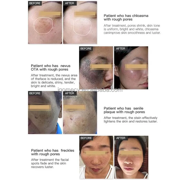 GOMECY-Professional-PicoLaser-532-755-1320-1064-Pico-Second-Tattoo-Removal-Laser-Machine-Pico-Laser-Tattoo-Removal-Picosecond