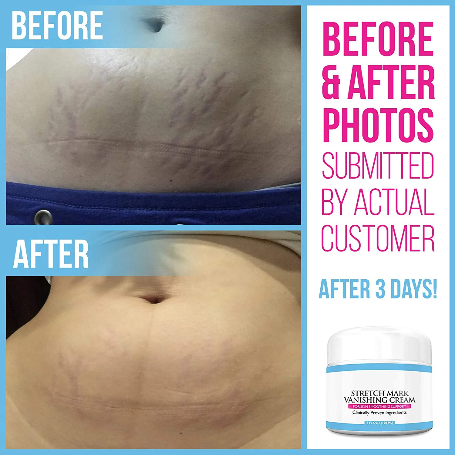 Увлажняющий Крем Для Удаления растяжек и шрамов от частной марки для ухода за телом