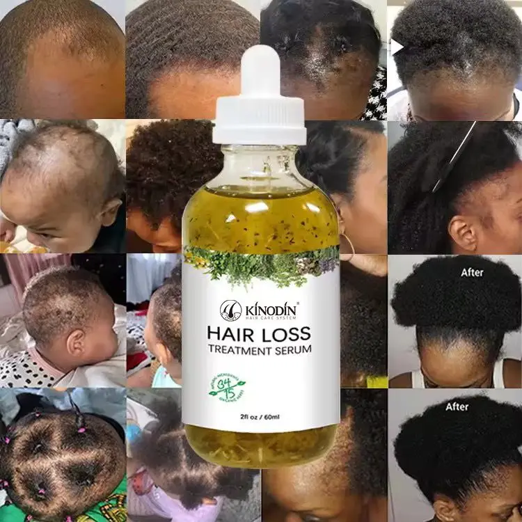 Китайский Лучший 7 дней имбирь веганское Натуральное эфирное масло для роста волос с розмарином Ямайское черное касторовое мужчин