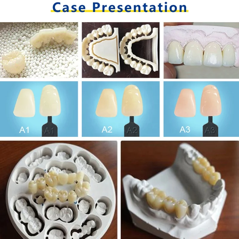 ZOTION Porcelain Fused to Zirconia Crowns Front Teeth Dental Ceramic Zirconium Discs