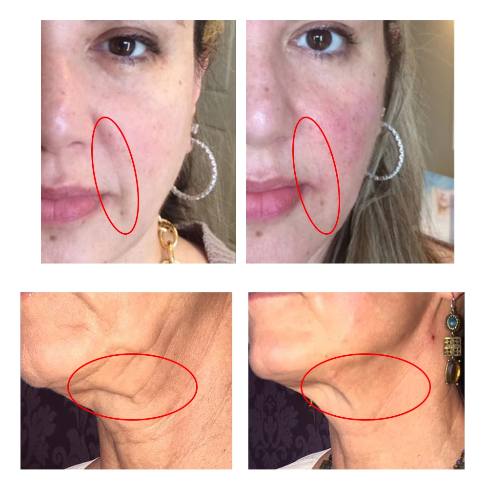 High quality factory medical surgical suture mesh thread 19G 60mm with fine gold thread pdo needle