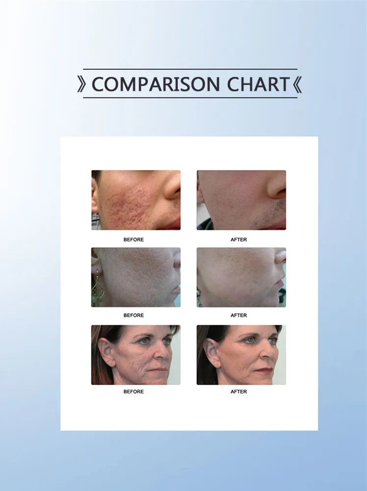 Carbon Dioxide Laser Machine Beauty Stretch Marks Skin Scar Removal Vaginal Tightening RF Tube