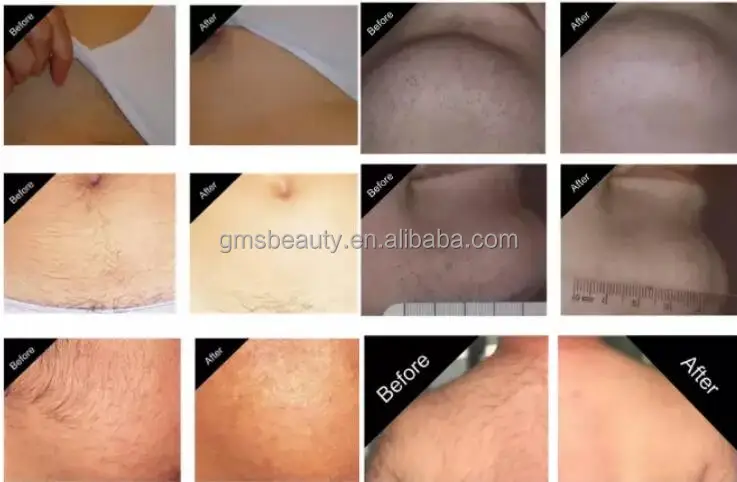 Laser Hair Removal Laser DISCOUNT Ice XL Diode Laser 755 808 1064nm Platinum Titanium 808nm Hair Removal Alexandrite