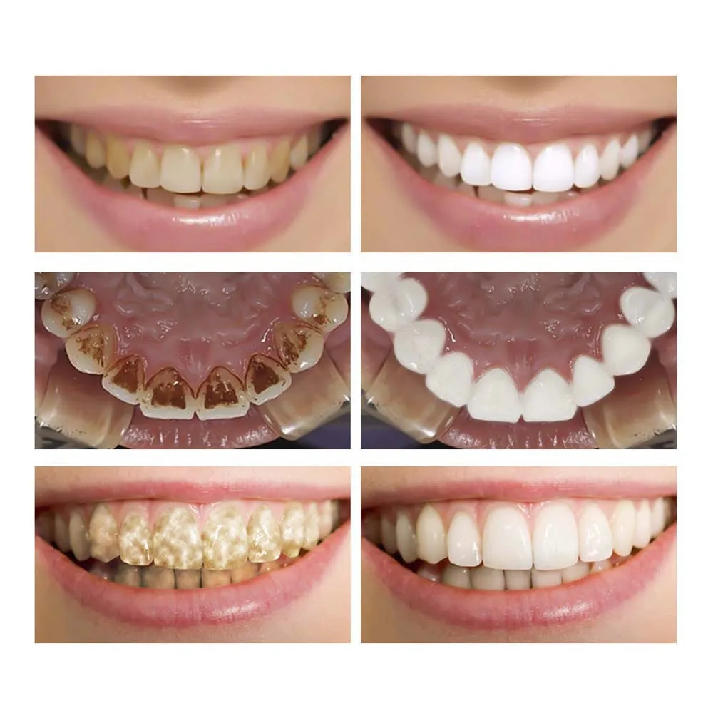 
LANBENA Professional Easy White Teeth Whitening Essence Liquid Oral Hygiene Teeth Cleaning Remove Plaque Stain Brighten Whiten 