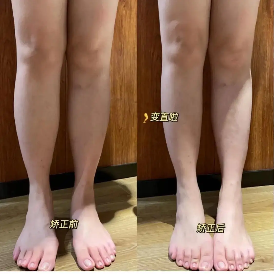 2PCS Toe soothing glue corrects O-shaped legs Japan Dashan toe ring corrects leg toe separator