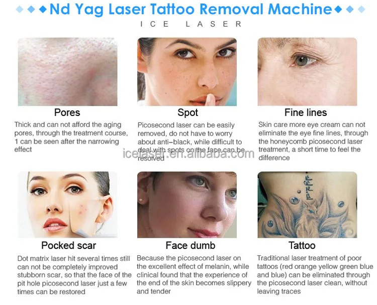 nd yag laser.jpg
