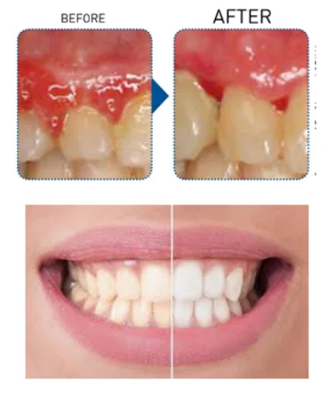 980nm 15w dental laser machine diode laser with treatment handpiece dental equipments