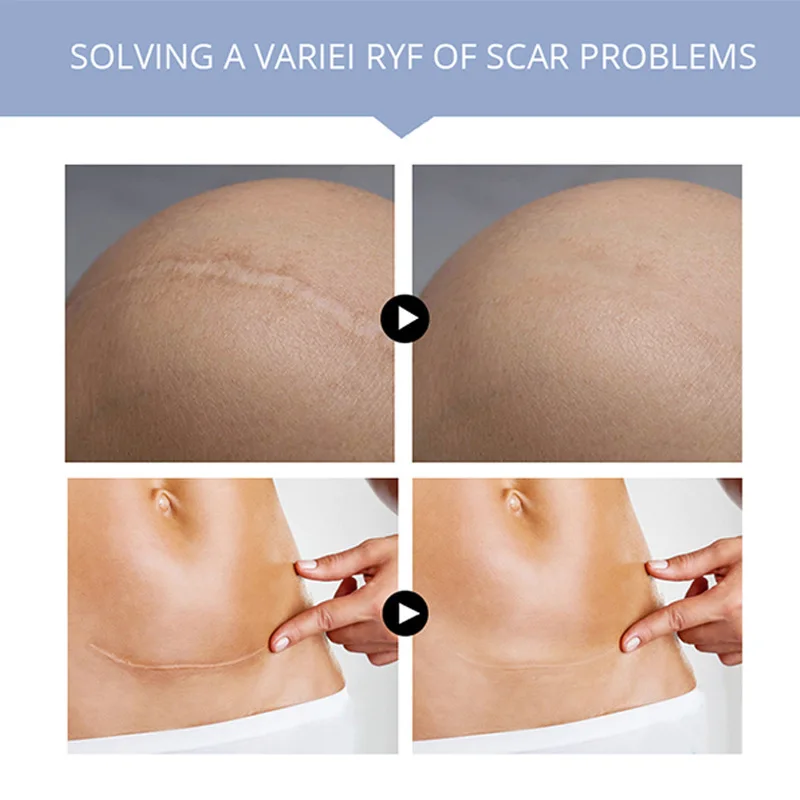 Chinese Supplier To Gets Rid Of Pimples Scars Cuts Remover And Facial Marks R Whitening