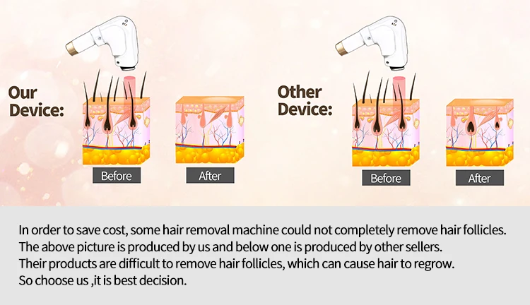 1200W High Power 755 808 1064 Alma Soprano Ice Titanium Professional Diode Laser Removal Hair Machine Device Price