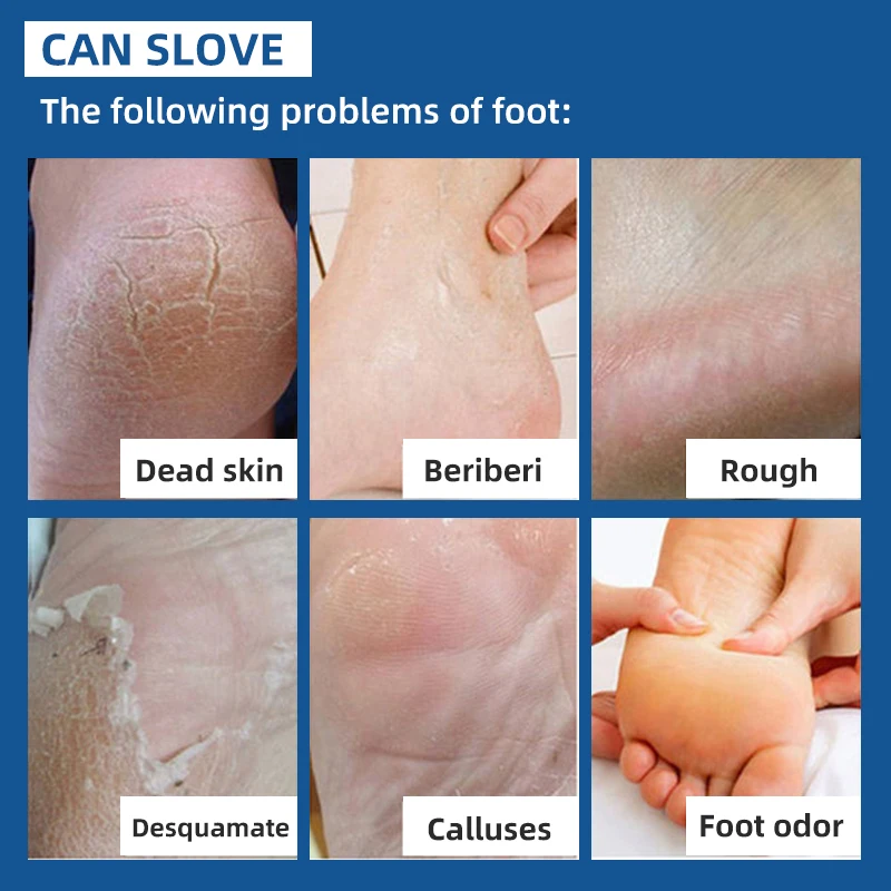 Sumax Wholesale 40% Urea Cream Foot Skin Care Cream For Dry Cracked Foot Heel