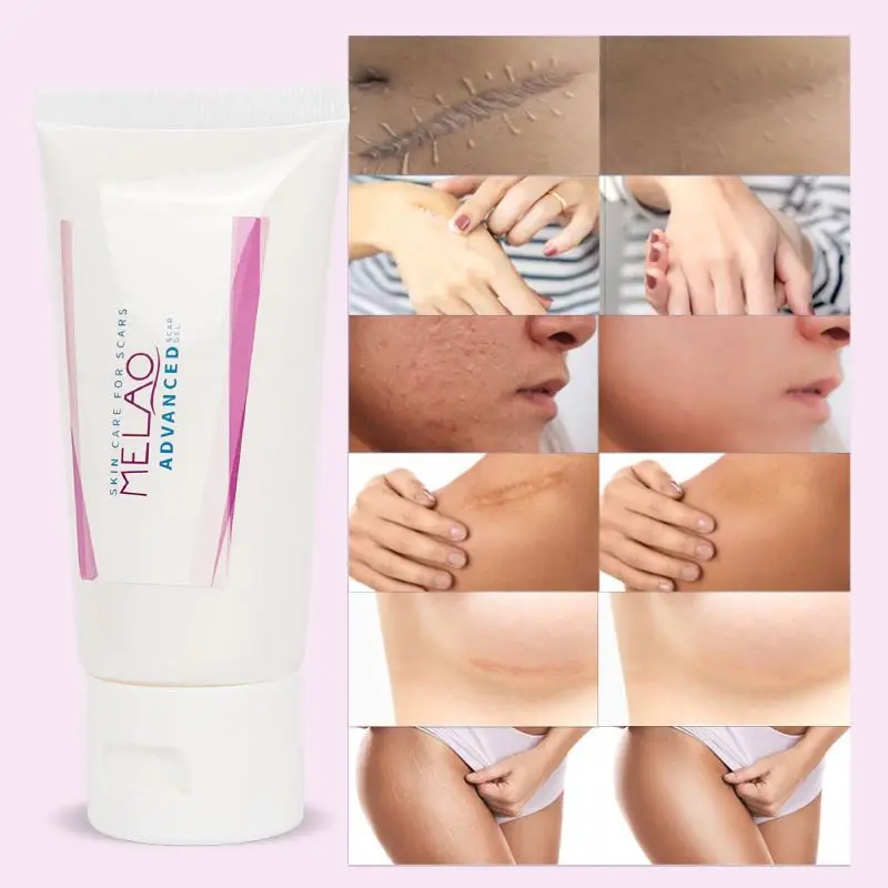 private label free sample Scar and anti acne mark removal gel ointment silicone advanced  silicone Scar Remover Gel