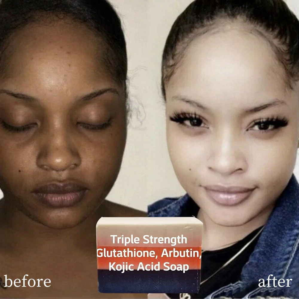 ЭКСТРА СИЛА Экстремальная койная кислота мыло для отбеливания кожи против акне натуральный травяной глутатион арбутин папайя экстракт из козьего
