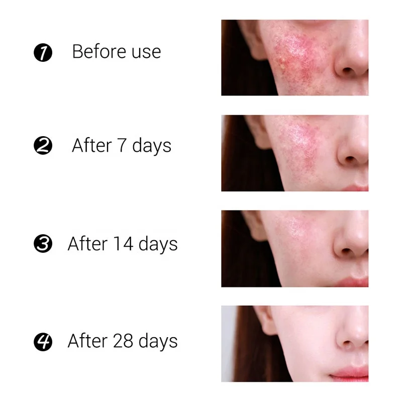 30g Acne Removal Freckle Cream Shrink Pores Whitening Moisturizing Oil Control Acne Cream Skin Care Treatment Face Cream