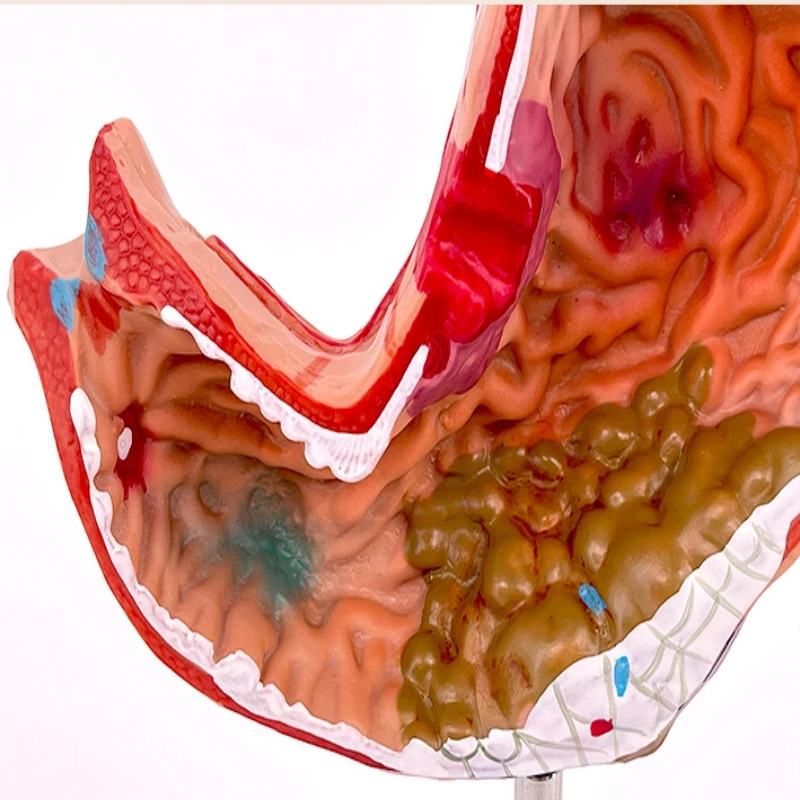Medical Stomach Demonstration Human Stomach Anatomy Pathology Gastric Digestive System Model Gastroenterology Toy Model
