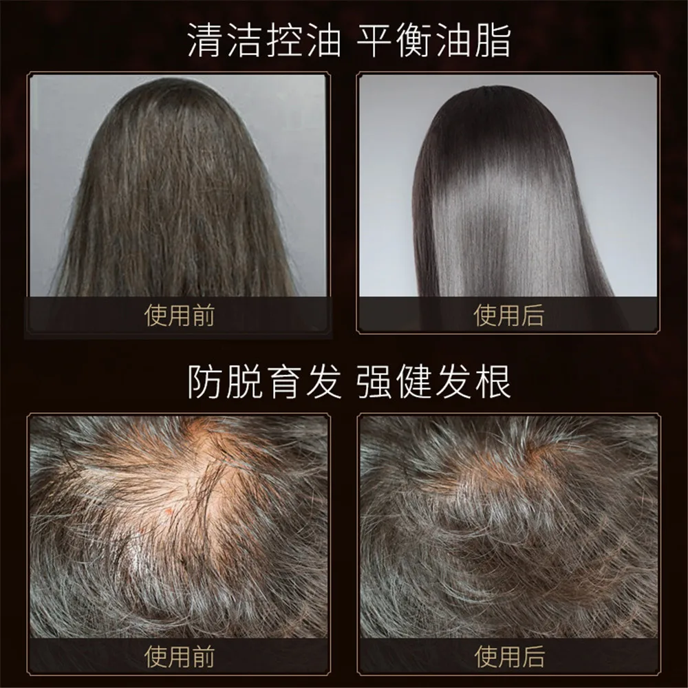 
Dry Shampoo Wholesale Organic All Natural Anti-Itching Shampoo Biotin Dandruff Shampoo Dry Shampoo Wholesale Organic All Natural Anti-Itching Shampoo Biotin Dandruff Shampoo