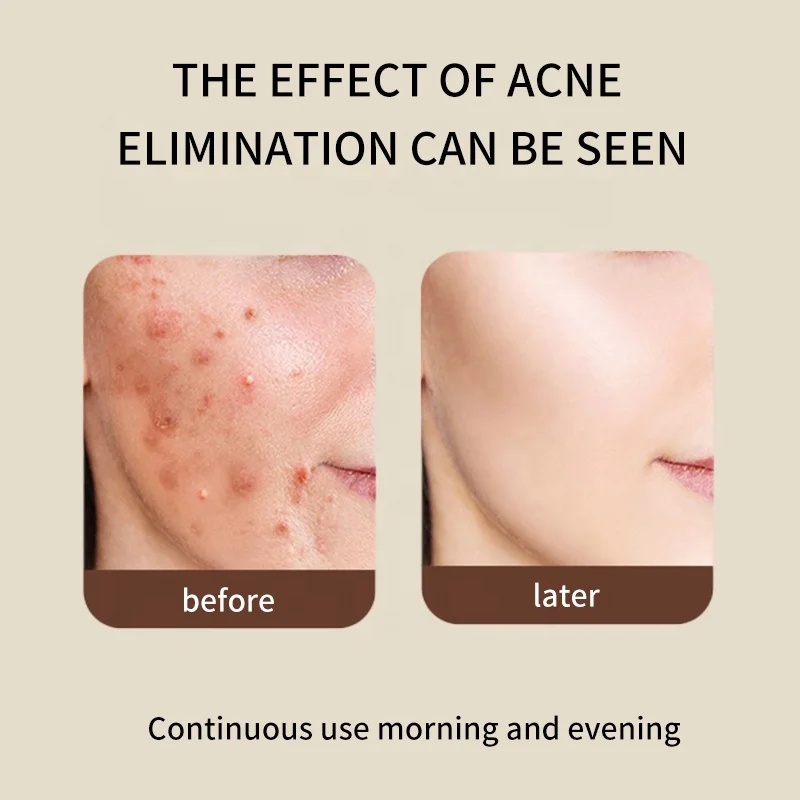 Custom Rapid Clear Stubborn Acne Spot Treatment Cream Anti Pimple Acne Treatment Face Cream For Acne Prone Skin