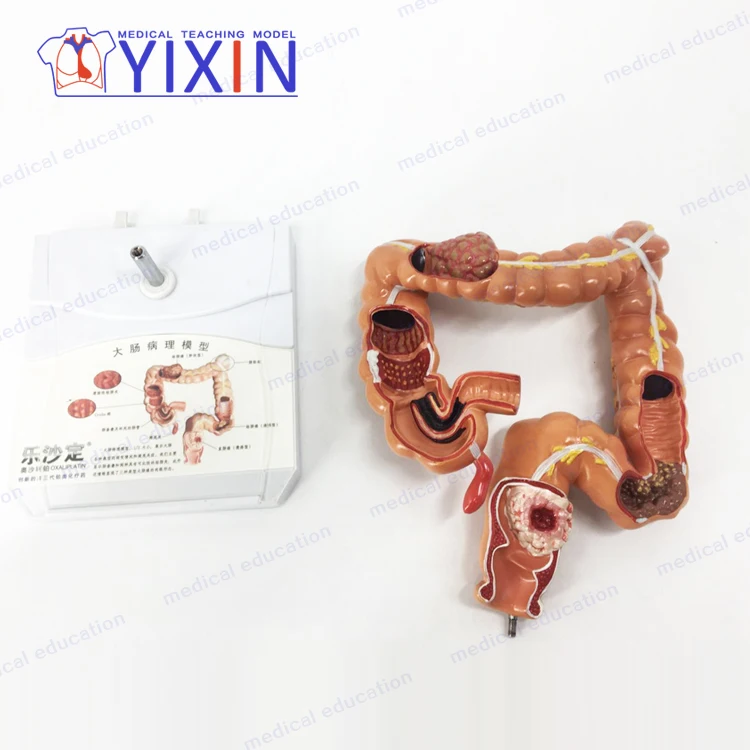 
YIXIN/Model of human colon disease Model of large intestine Pathological,Disease Large Intestines 
