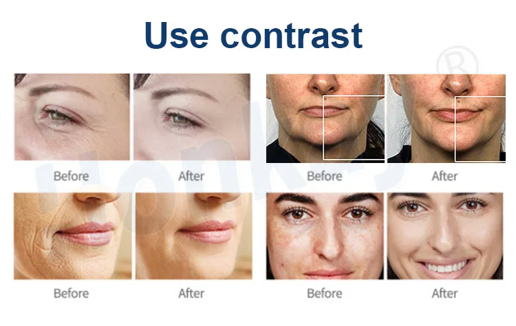 plasma Facial Device 2 In 1 plasma Therapy Acne Treatment Skin Rejuvenation Facial Device Beauty Machine plasma Beauty