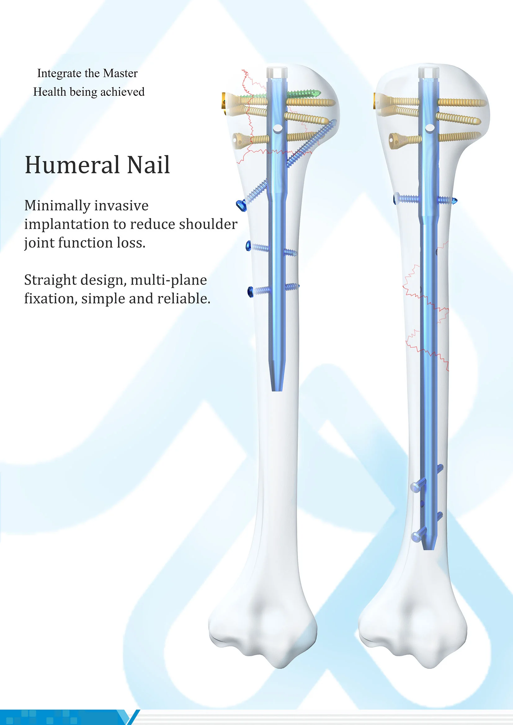 Multiloc Humeral Intramedullary Nail Interlocking Orthopedic Implants Titanium With Locking Screw