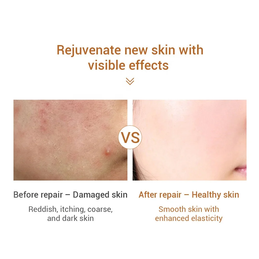 LANBENA Ectoin Soothing Serum Anti Allergic Enhance Skin Bottom Repairing Acne Marks Damage Moisturizing Sensitive Skin 30ml