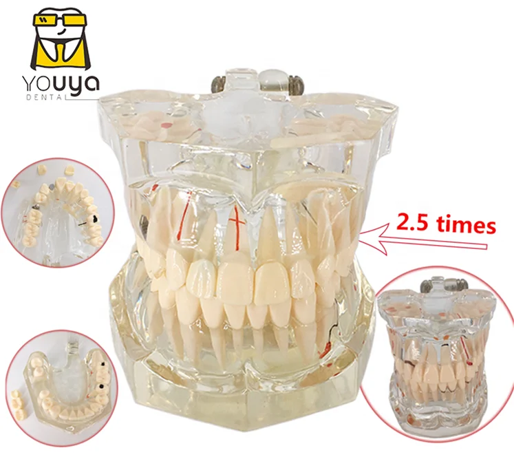 2.5 Times Larger Dentistry Teaching Dental Model Implant Model Tooth Model
