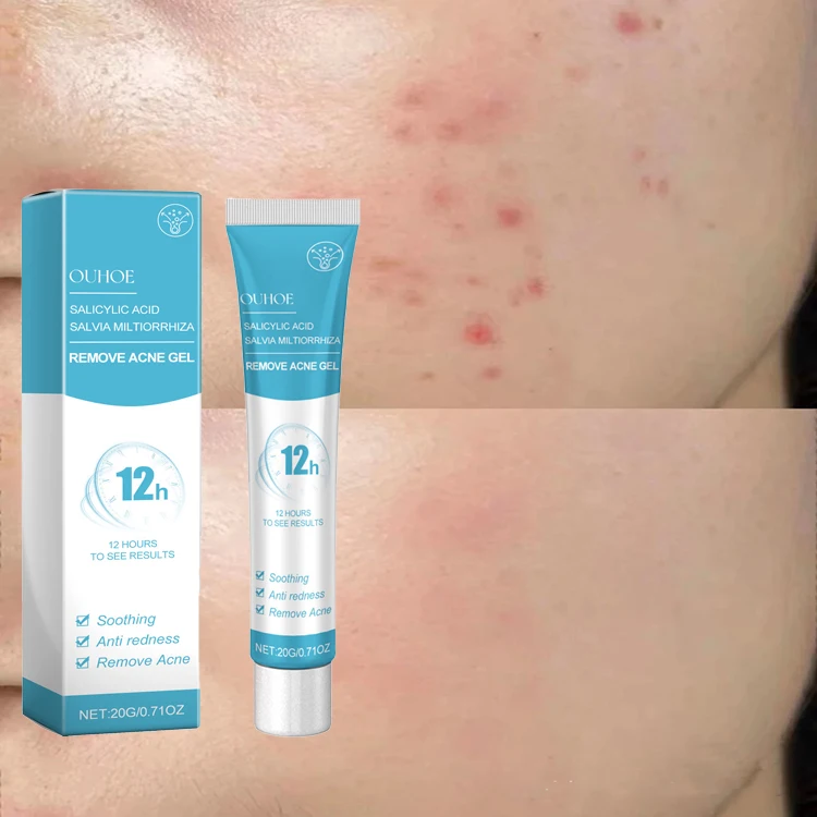 Cleaning Repair Pimples Smooths Skin Face Acid Gel Shrinks Pores Treatment Acne Salicylic Acid Gel