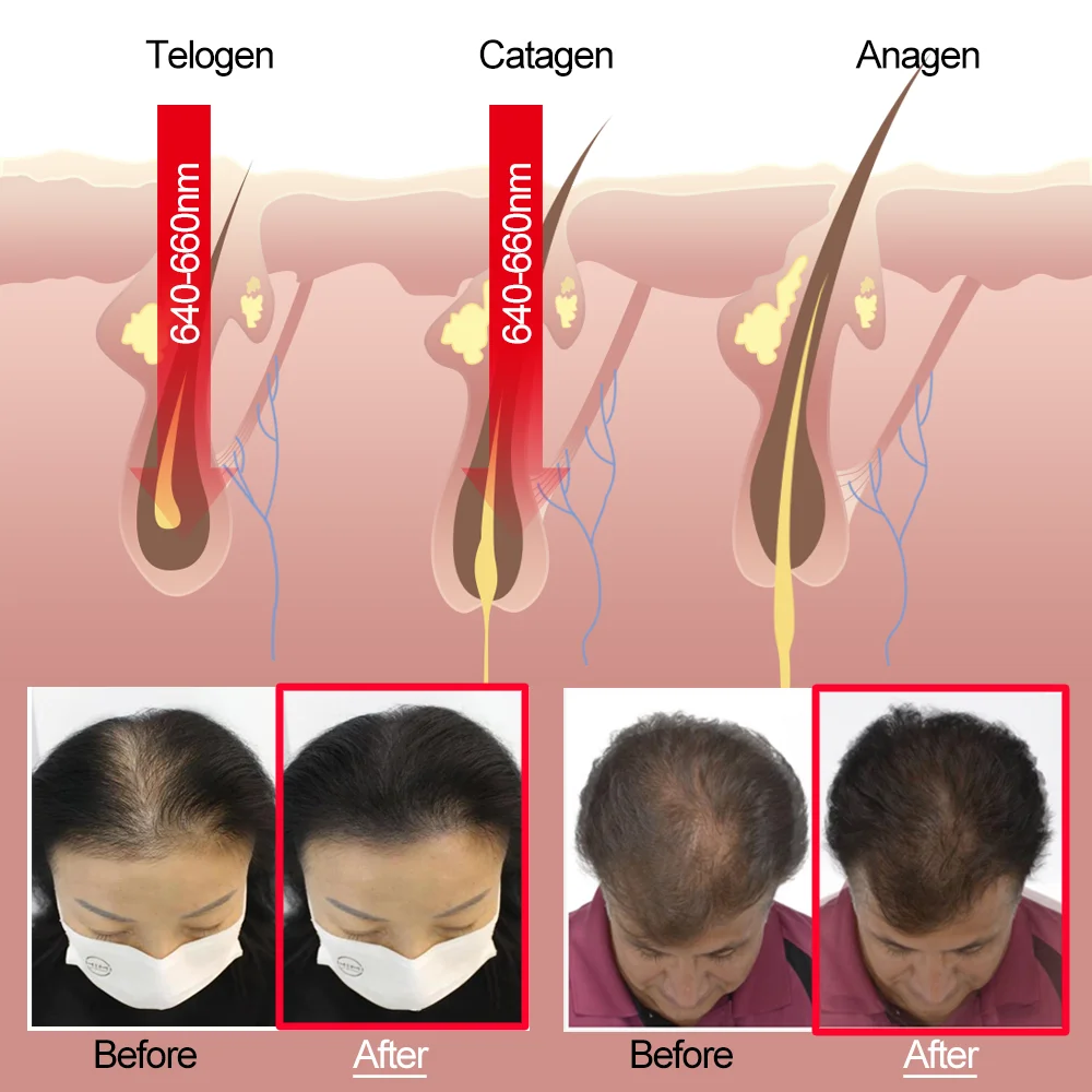 Best Hair Growth Products LS-D601 Professional Infrared Hair Growth Machine Top Supplier LLLT Laser Wireless Hair Growth Helmet