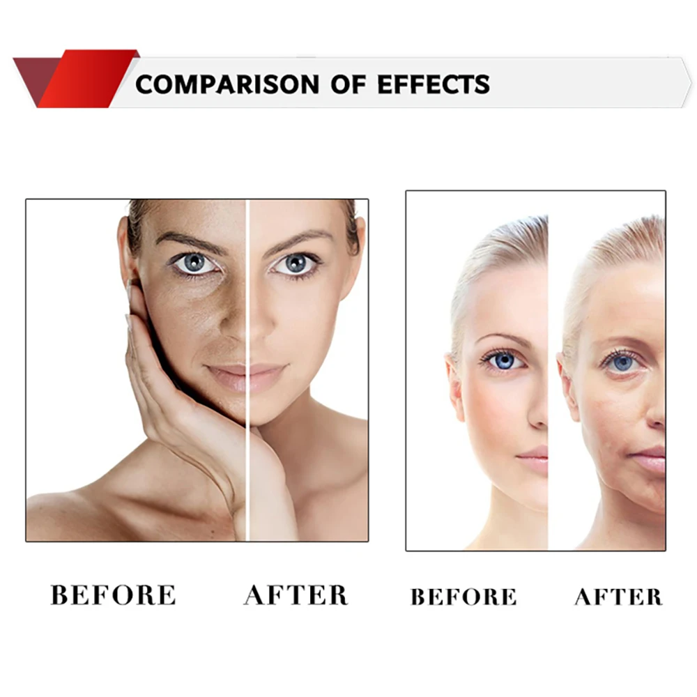 18g 100 мм W Cog 3D Pdo резьба для лифтинга лица высокого качества