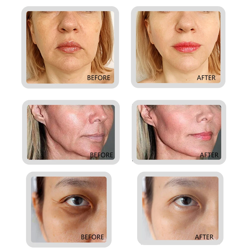 Wholesales Price 30G 38mm Beauty Salons Use Mono Thread Pdo For Mouth