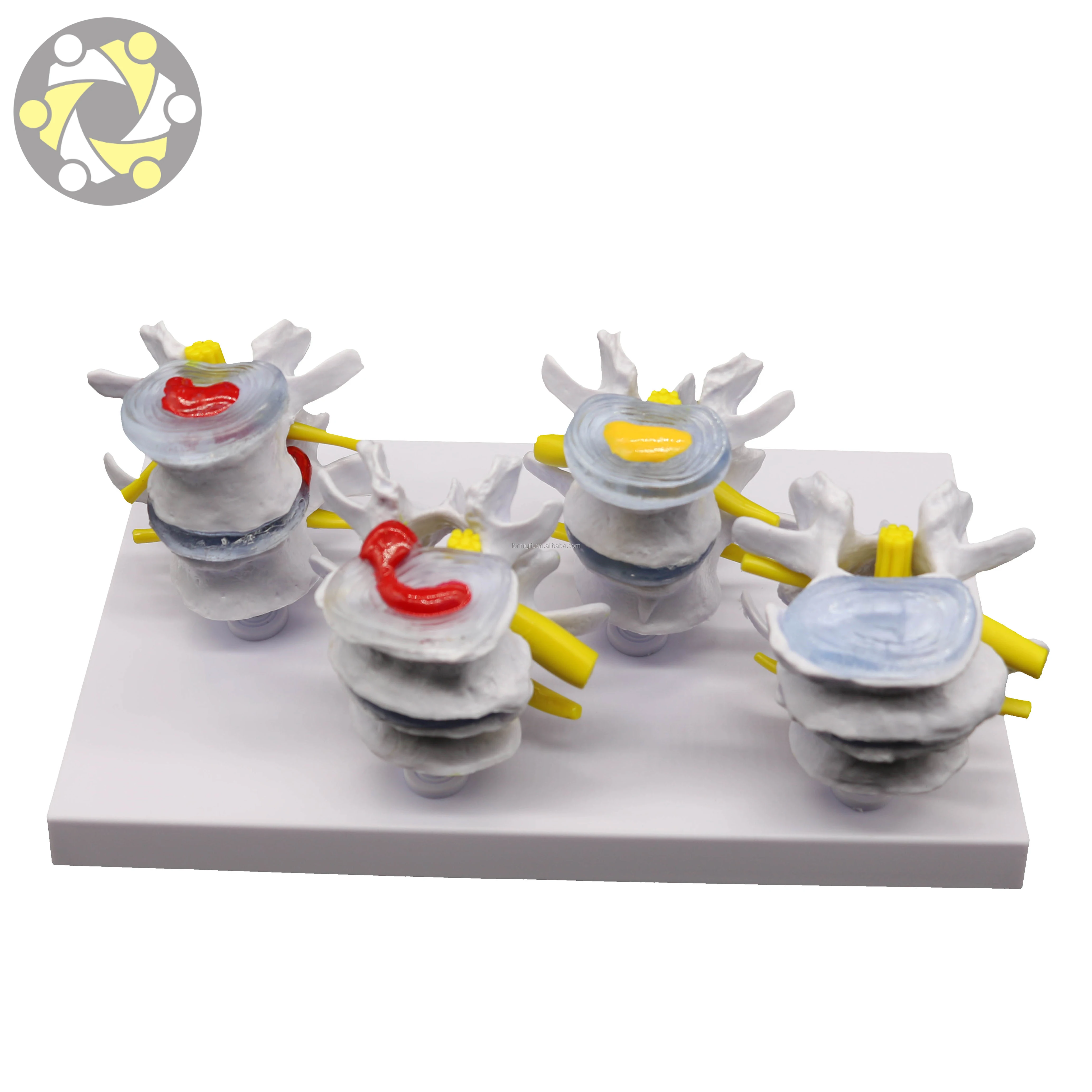 Medical Science 4 Stage Pathological Lumbar Skeleton Model