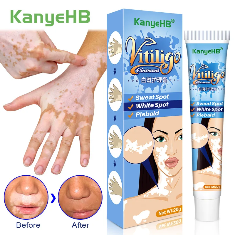 20g Herbal Vitiligo Ointment Remove Ringworm White Spot Removal Skin White Spot Leukoplakia Disease Treatment Cream Body Care