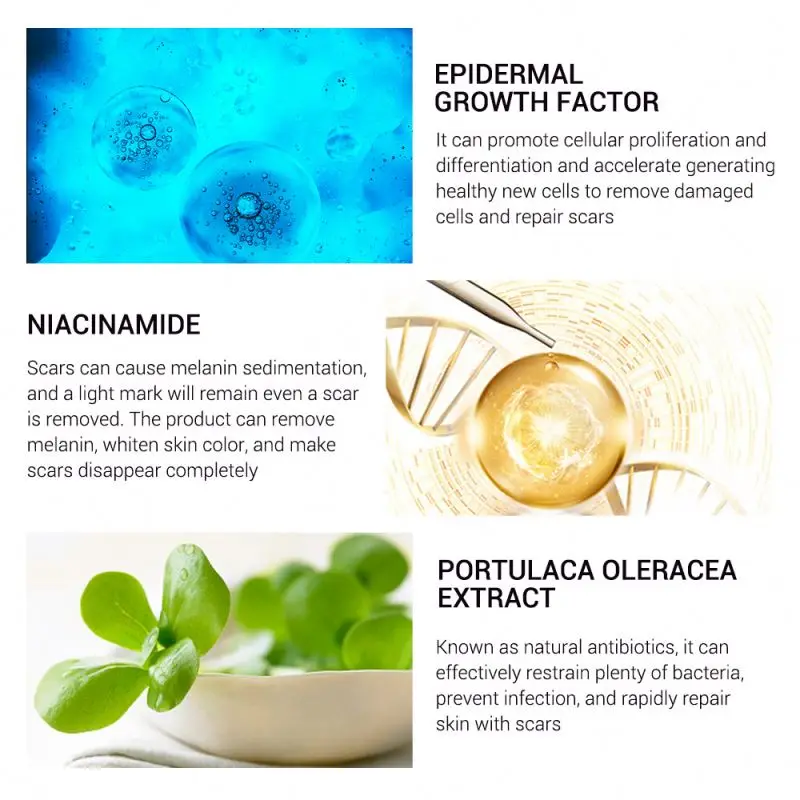 BREYLEE 30g Acne Scar Removal Cream Natural Herbal Skin Repair Acne Treatment Fade Stretch Marks Scar Remover Cream