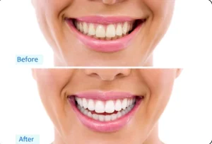 980nm 15w dental laser machine diode laser with treatment handpiece dental equipments